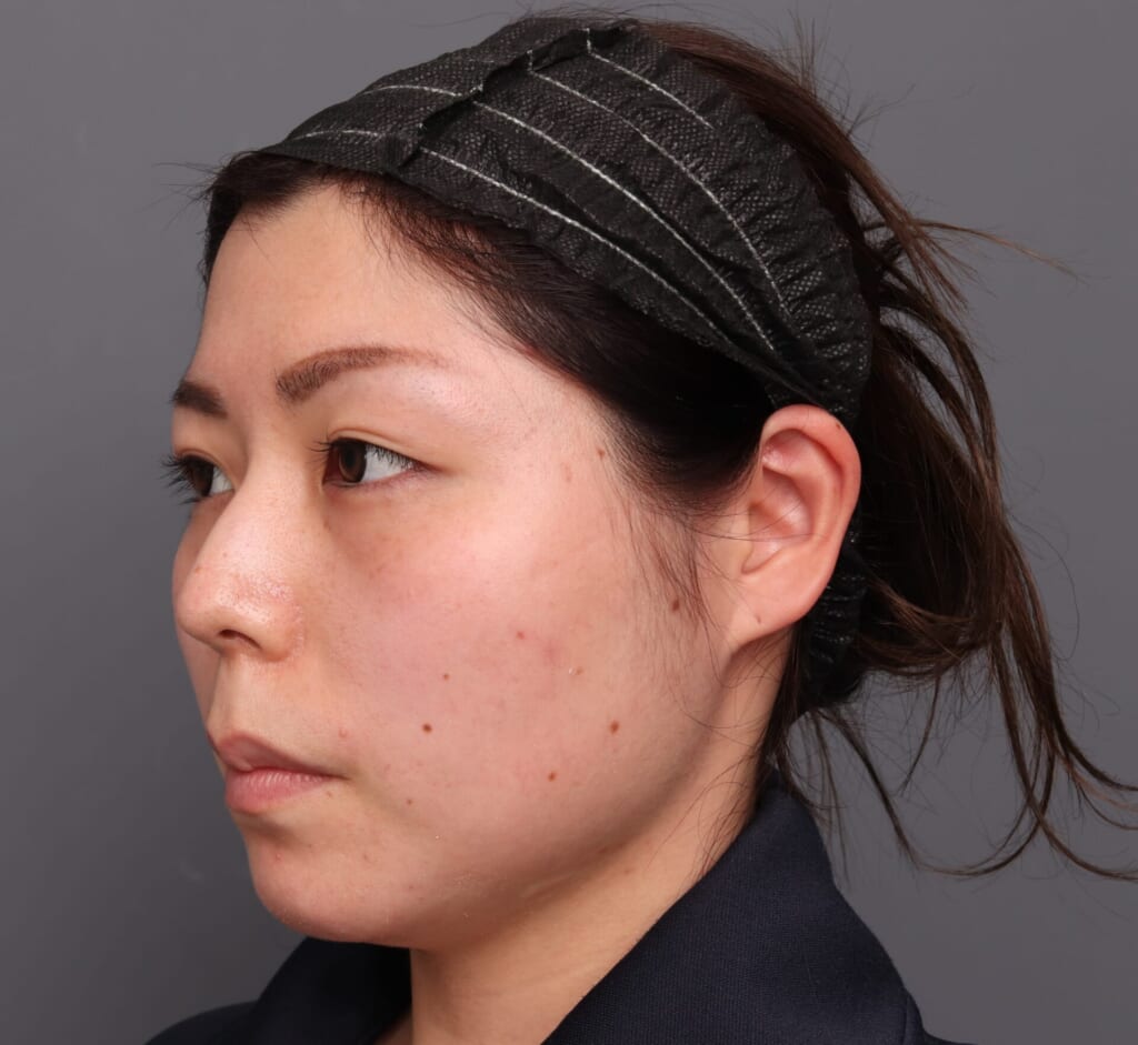 ベイザーですっきり