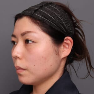 ベイザーですっきり
