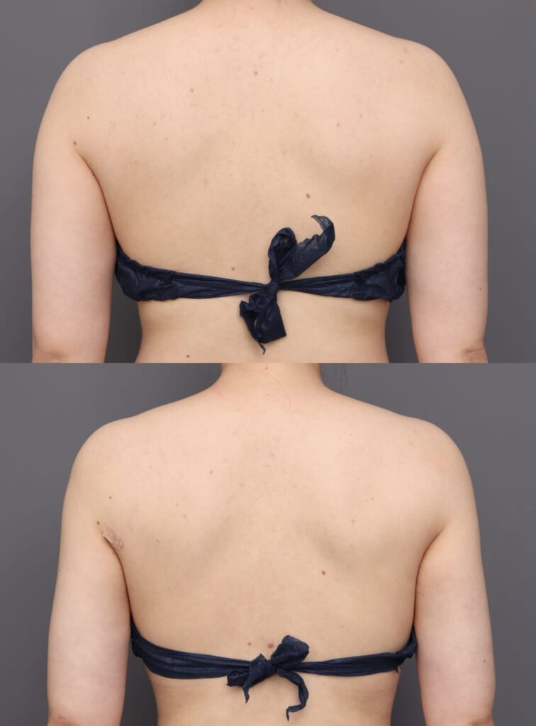 華奢な背中へ 安部光洋の脂肪吸引ブログ