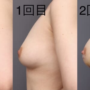 2回目豊胸でサイズアップ