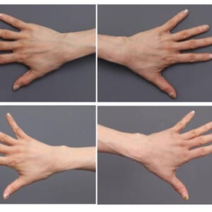 手の甲の血管が気になる方には、、ハンドリバイブ