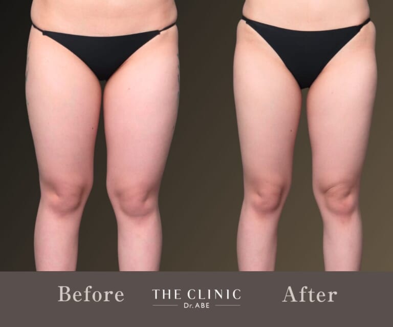 太ももでもう悩まない！